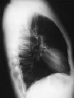 Lateral Chest Radiograph